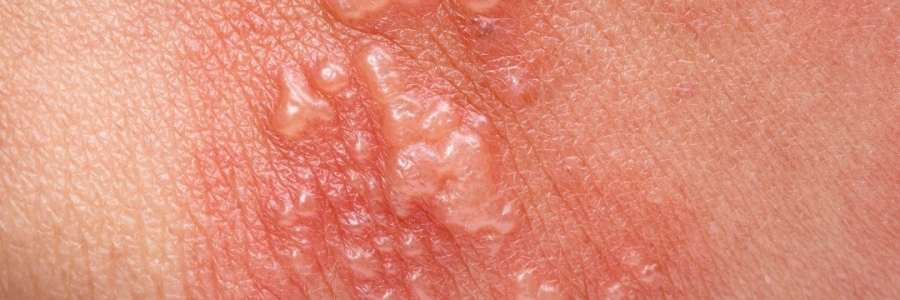 艾灸后起了小水泡，居然是邪氣在“逃跑”！